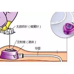 植入式給藥裝置.jpg